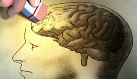  Alzheimer diş tedavisiyle bulaşabilir 